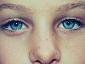 how to remove freckles