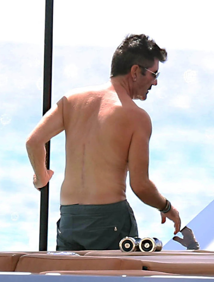 simon cowell scar